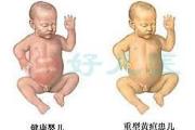 新生儿黄疸中药古法今用之不同