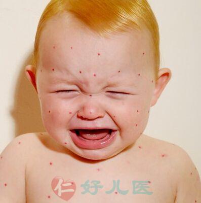 湿疹、荨麻疹.jpg
