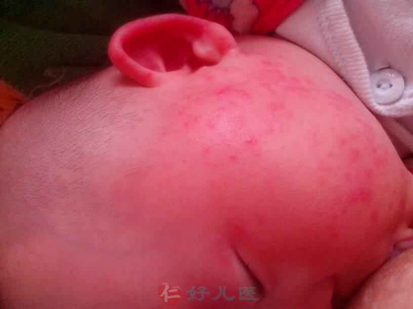 小儿湿疹.jpg