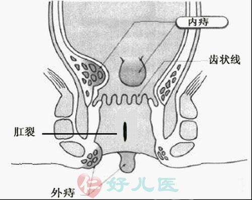 痔疮示意图.jpg