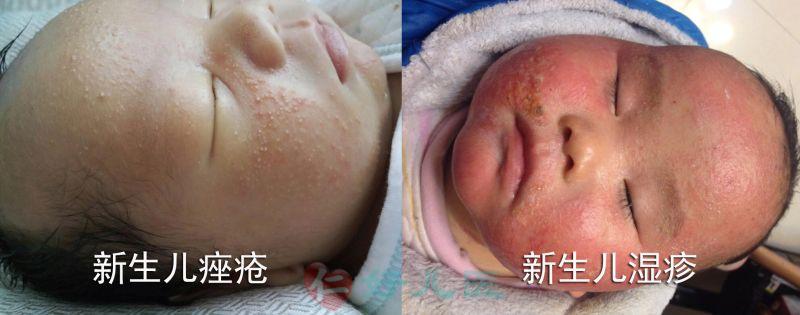 新生儿痤疮与湿疹对比800.jpg