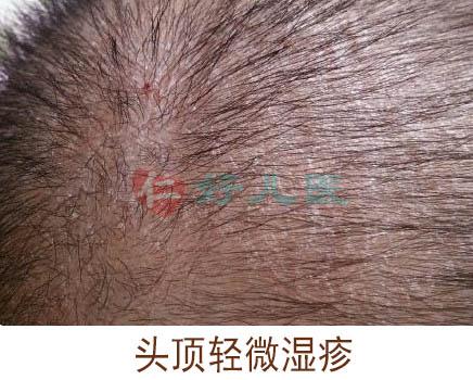 头顶轻微湿疹.jpg