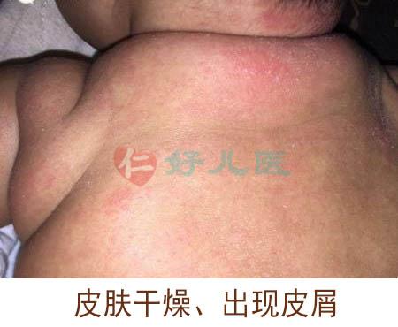 皮肤干燥红疹湿疹.jpeg