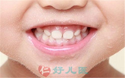 婴儿护牙.jpg